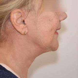 Brystforstørrende operation + brystløft med et flot resultat