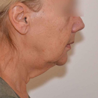 Brystforstørrende operation + brystløft med et flot resultat