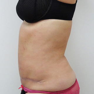 After Maveplastik / hudreduktion