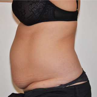 Before Maveplastik / hudreduktion