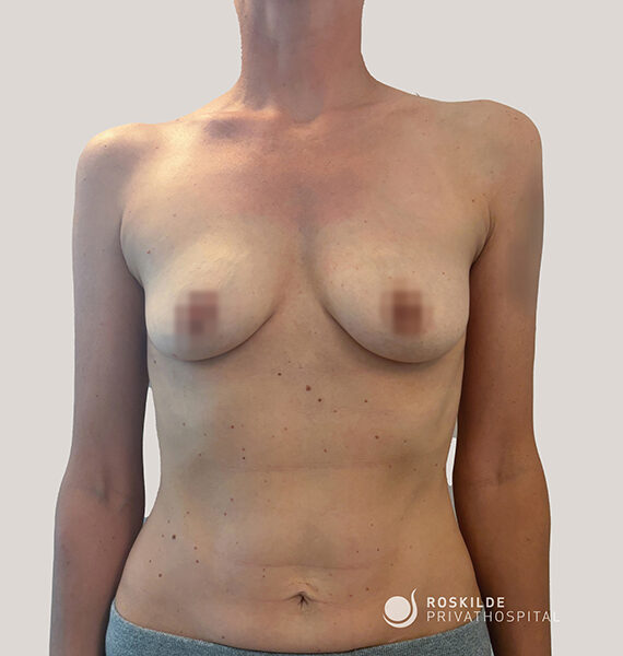 Silimed, dråbeformede implantater, 220 ml, moderat profil, natural-modellen