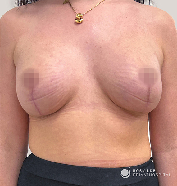 Denne patient har fået et stort brystløft kombineret med Silimed, runde implantater, 335 ml, True Texture Maximum